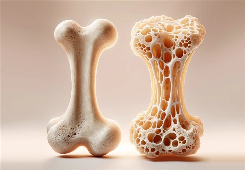 شیوع 80درصدی مشکلات استخوانی در ایرانیان بالای 50سال